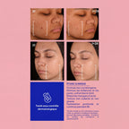 EffaCreme triple action acide azelaïque